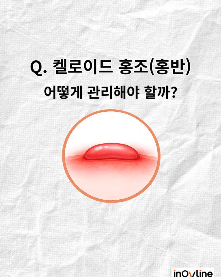 켈로이드 홍조(홍반) 어떻게 관리해야 할까?