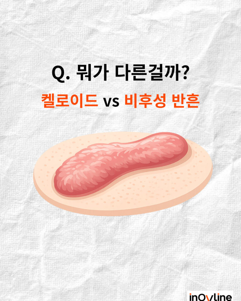 켈로이드, 비후성반흔 뭐가 다른걸까? 차이점