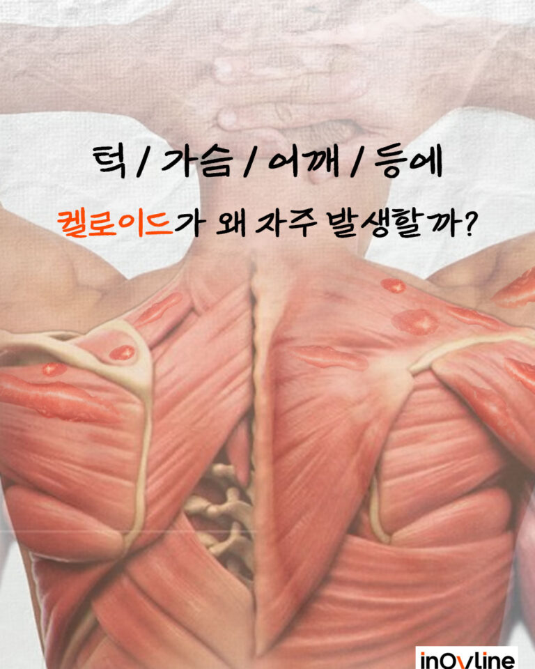 턱, 가슴, 어깨 등에 켈로이드가 왜 자주 발생할까?
